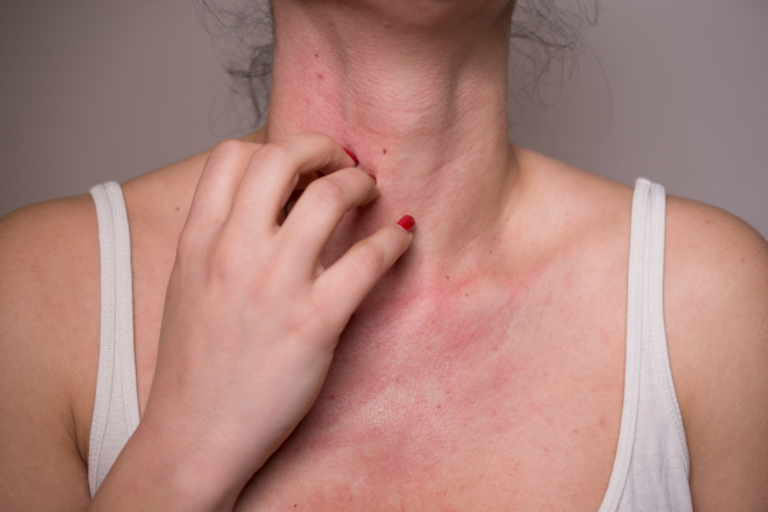 persona rascándose el cuello por alergia al sol